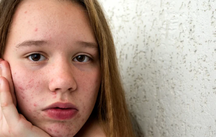 Teenager with acne looking at bathroom mirror with skincare products including cleanser and moisturizer on counter