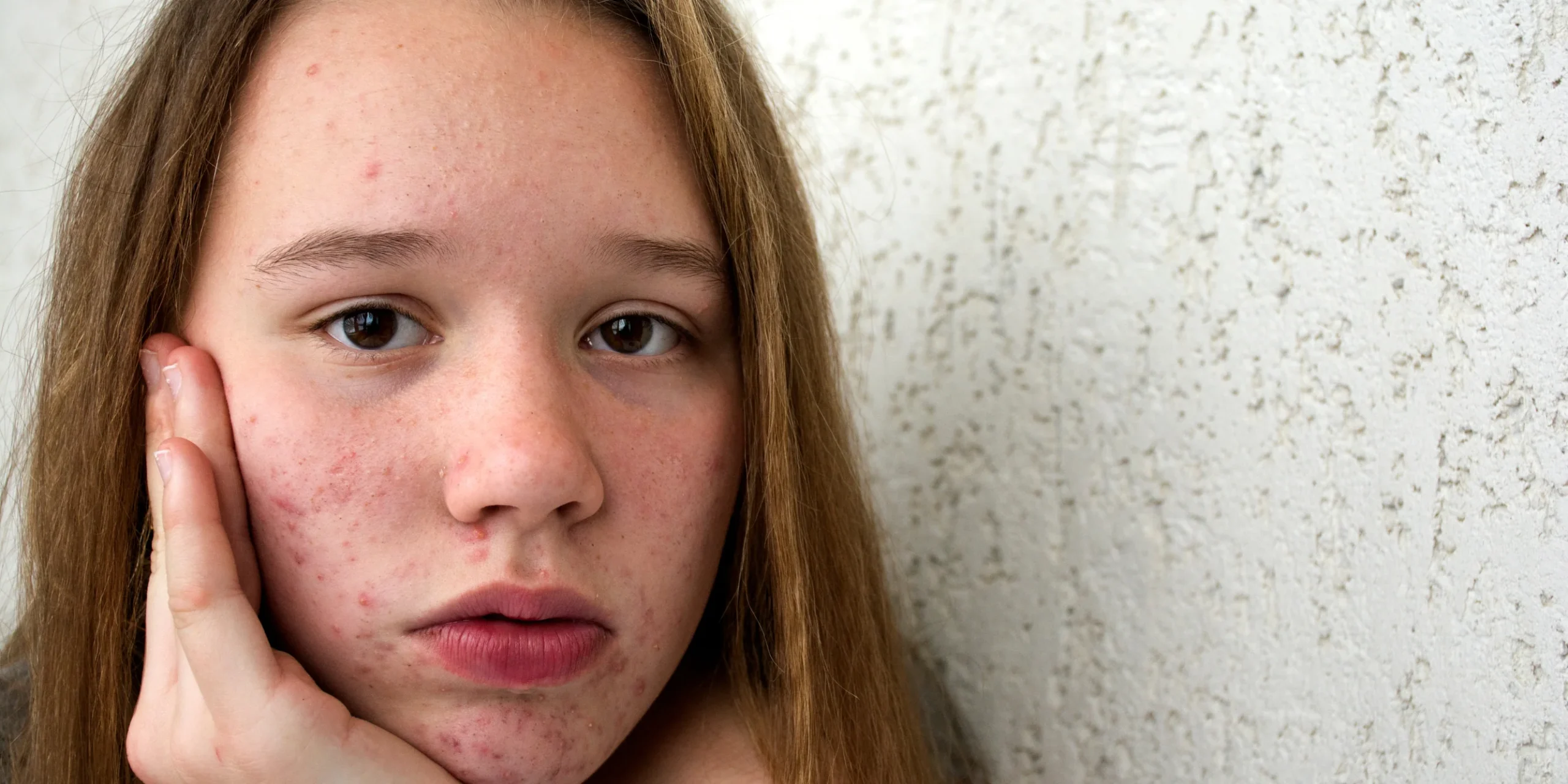 Teenager with acne looking at bathroom mirror with skincare products including cleanser and moisturizer on counter