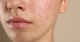 Steroid-induced acne on face, back and shoulders with inflamed red bumps and pustules from corticosteroid medication side effects